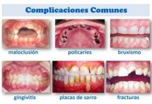 ESCOLARES DEBEN PREVENIR LA CARIES, INFLAMACION DE SUS ENCIAS, ENTRE OTRAS ENFERMEDADES DENTALES