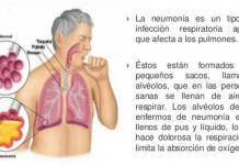 LA NEUMONÃA PUEDE SER MORTAL SI NO SE ATIENDE A TIEMPO