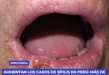AUMENTAN LOS CASOS DE SÍFILIS EN PERÚ: MÁS DE 46 MIL REGISTRADOS Y JÓVENES SON LOS MÁS AFECTADOS