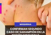 MOQUEGUA | CONFIRMAN SEGUNDO CASO DE SARAMPIÓN EN LA REGIÓN MOQUEGUA: MENOR DE 10 MESES DIO POSITIVO EN ILO.