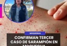 MOQUEGUA | CONFIRMAN TERCER CASO DE SARAMPIÓN EN MOQUEGUA.